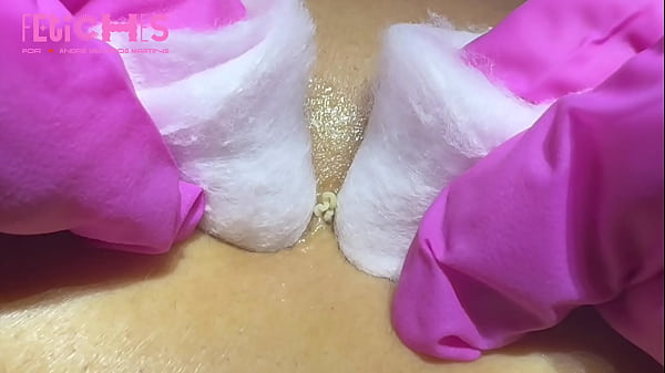 Extraç_ã_o de cravos e espinhas